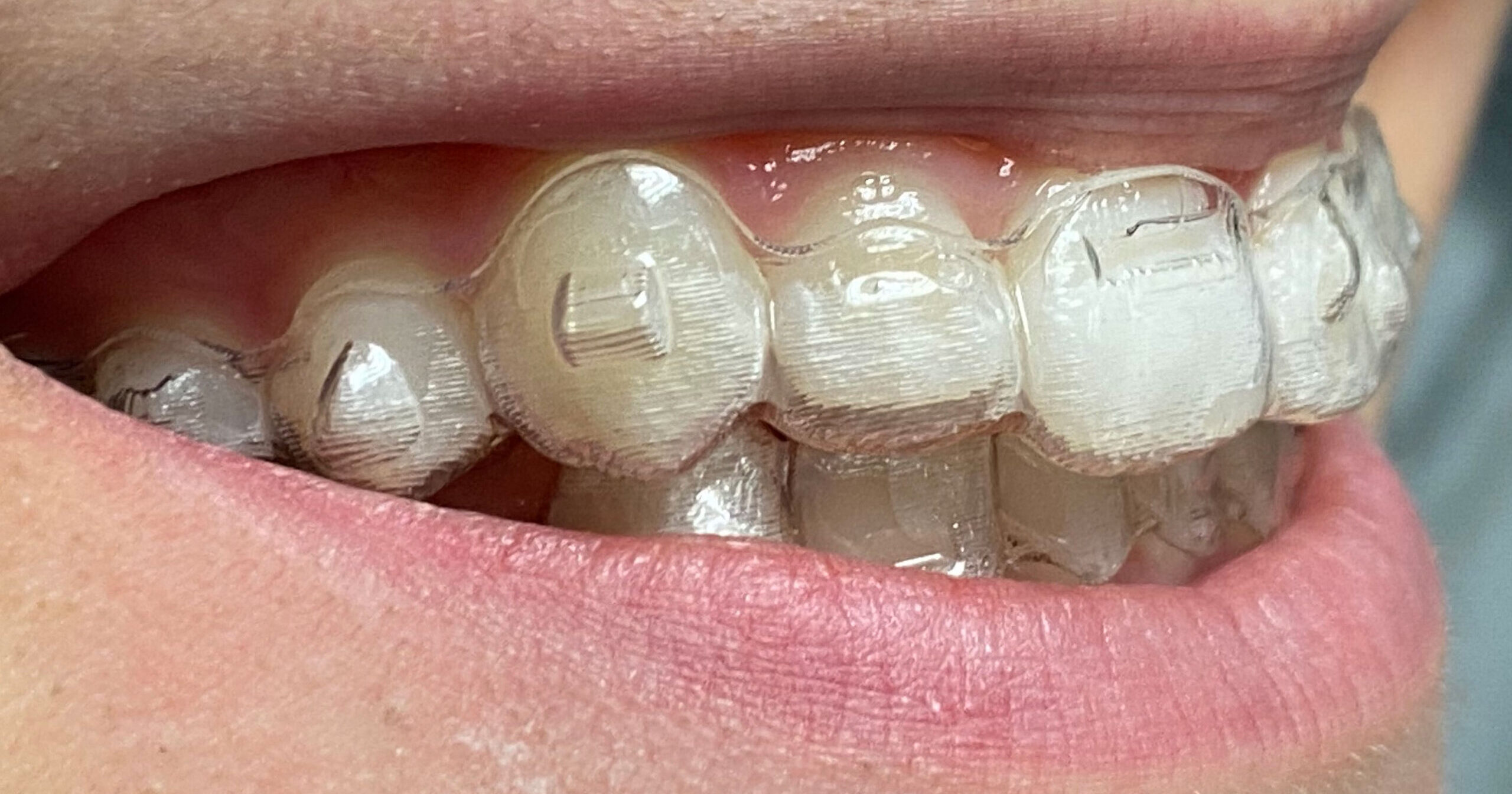 Ortodoncia invisible