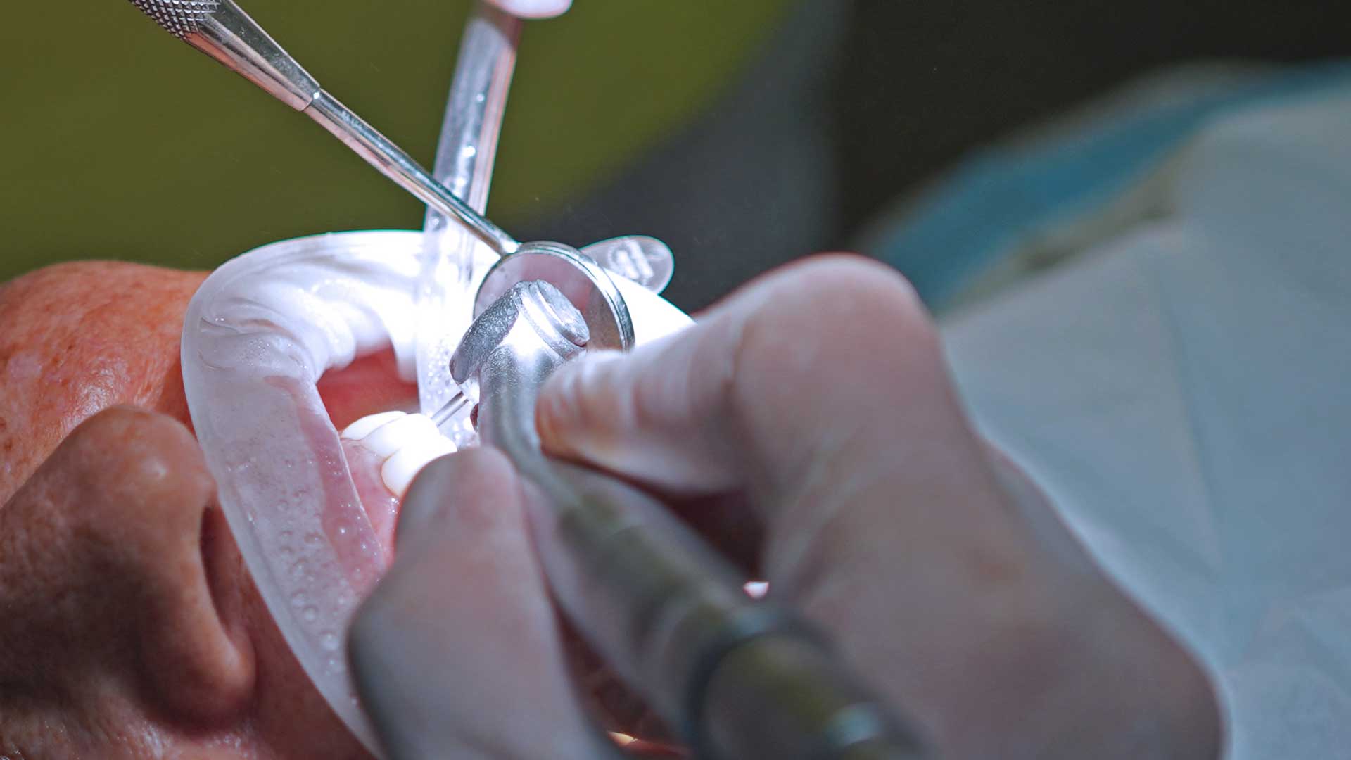 Estética dental valencia