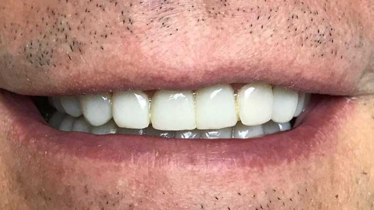 Dentaura post tratamiento dental